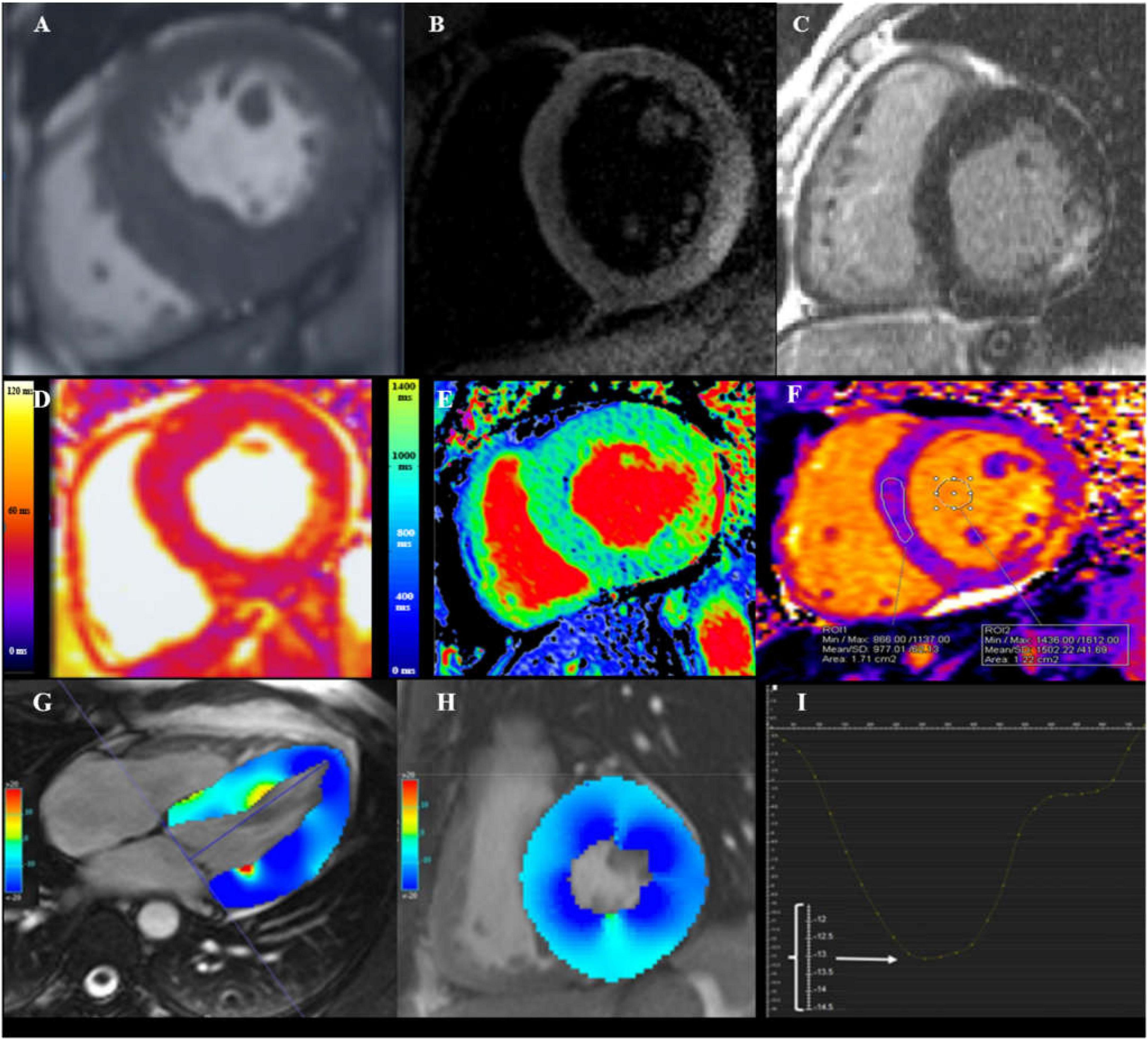 Cardiac MRI in Fabry disease